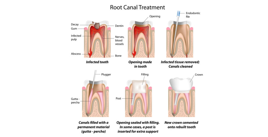 root canal treatment in indore