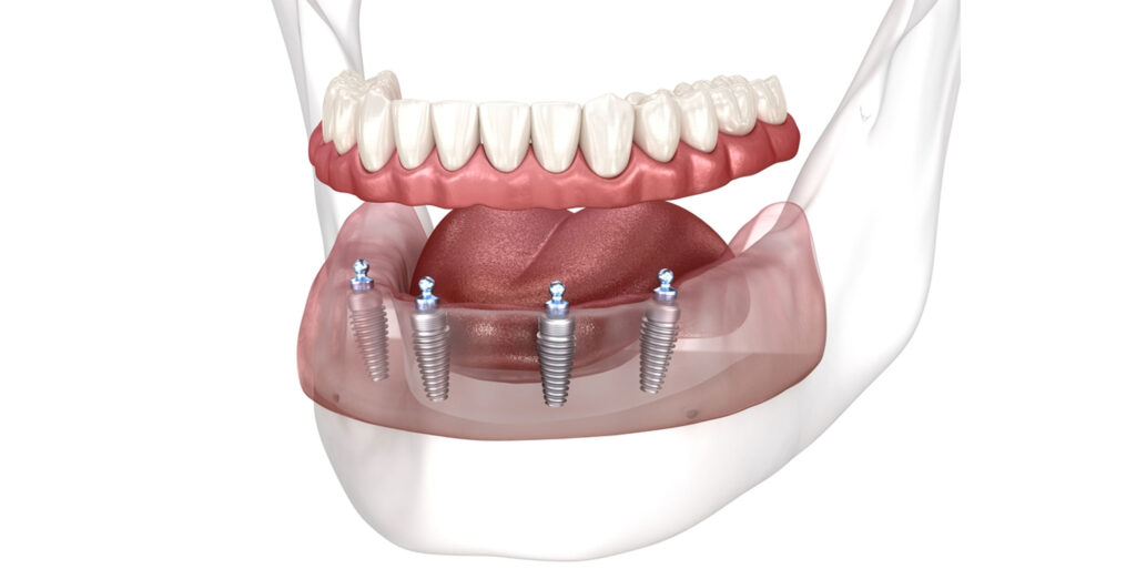 dental crown treatment in indore