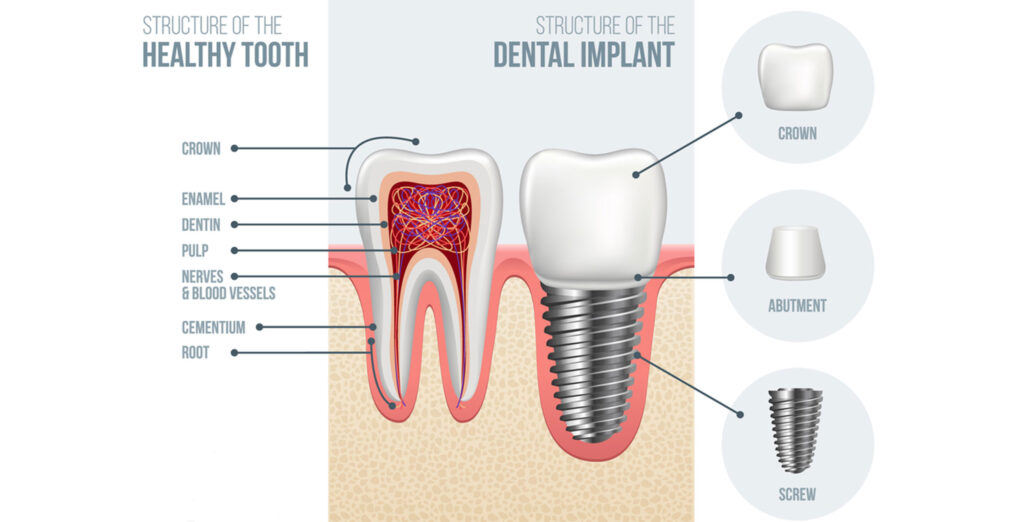 implantologist in indore