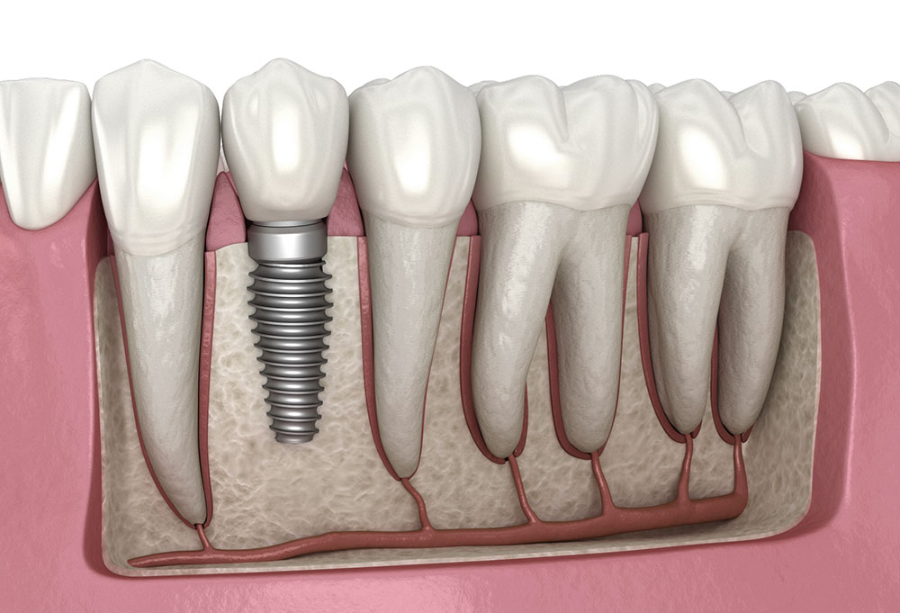 dental implants in indore