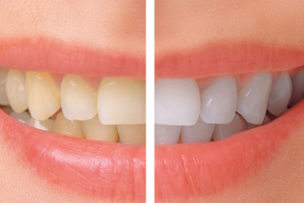 dentist in Indore for teeth whitening