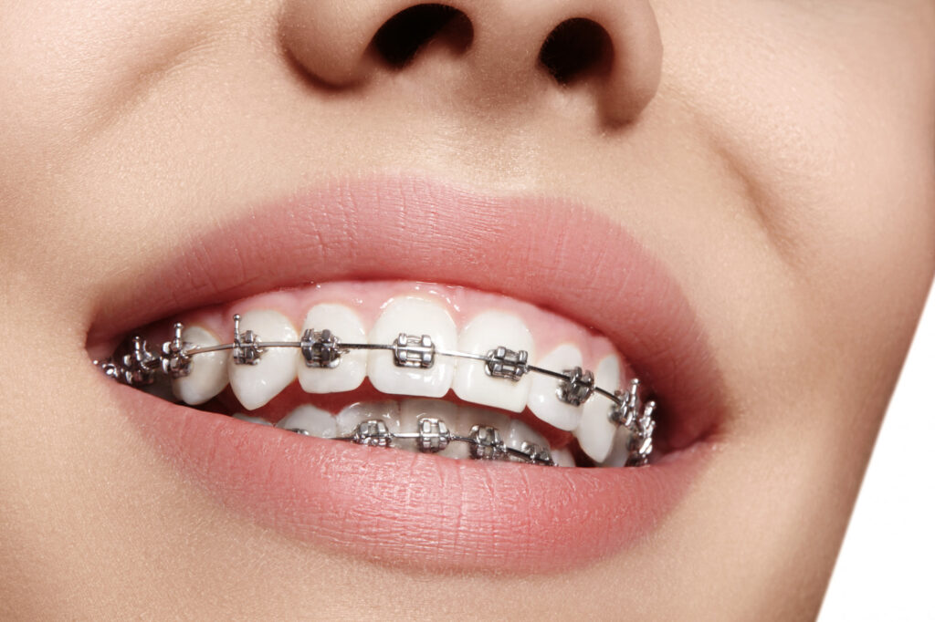 dental braces in indore