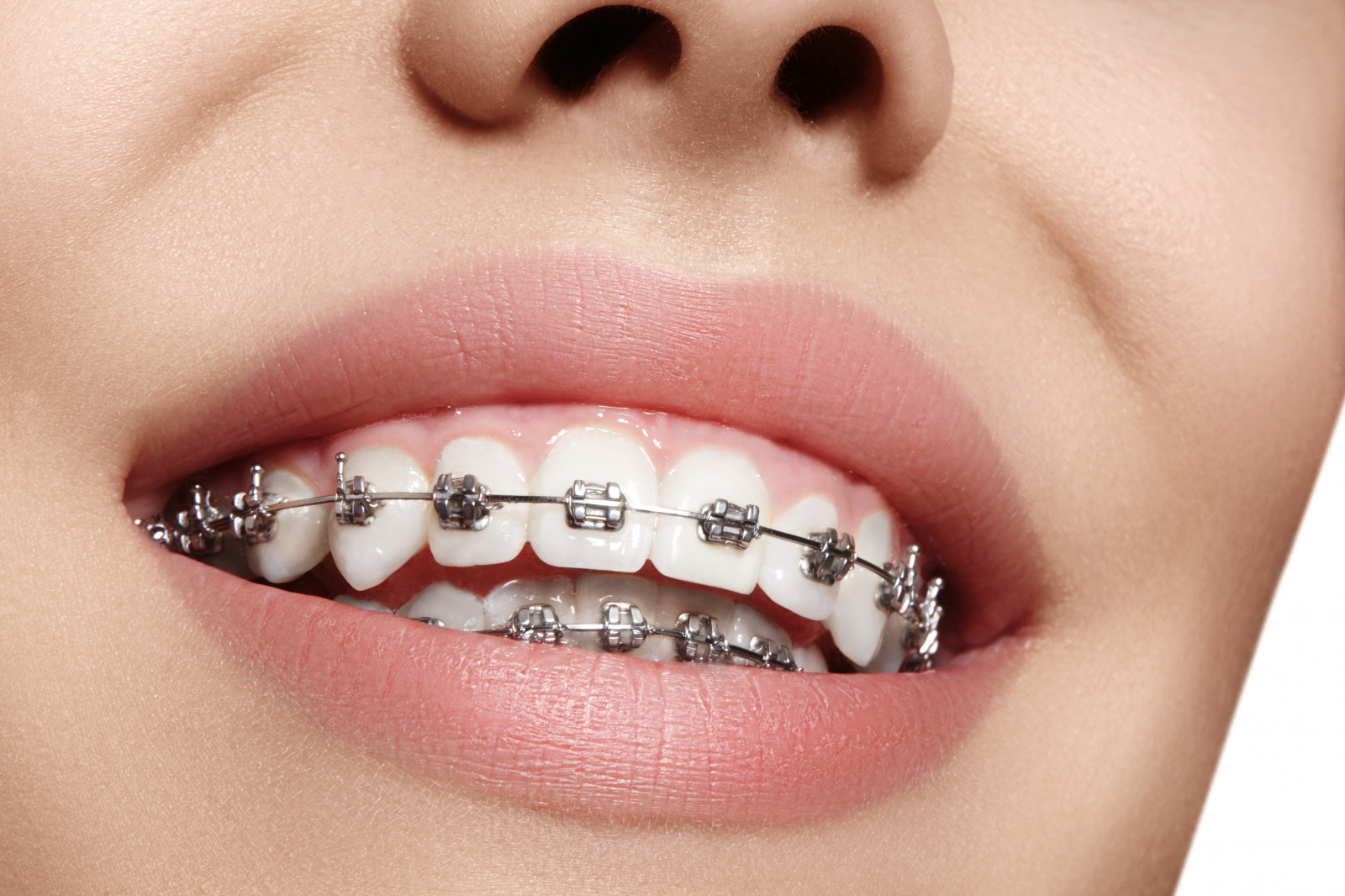  dental braces in indore