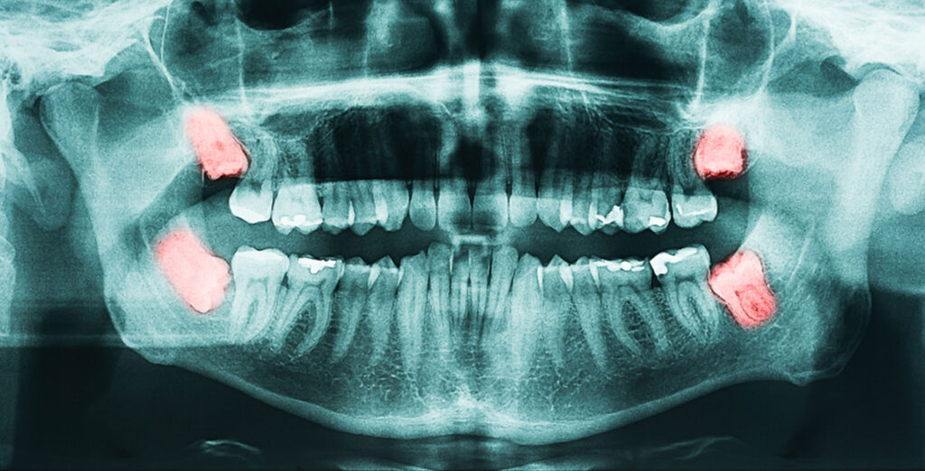 wisdom tooth removal in indore