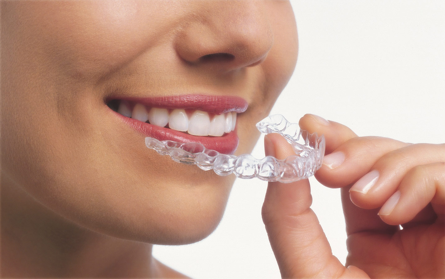 braces invisible aligners in indore