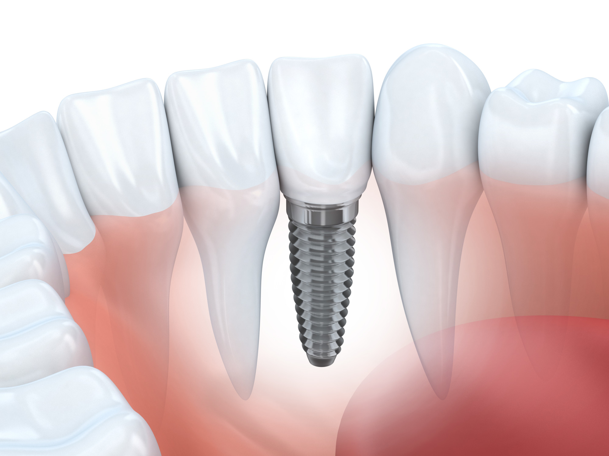 dental implant in indore, root canal treatment in indore, indore dental hospital