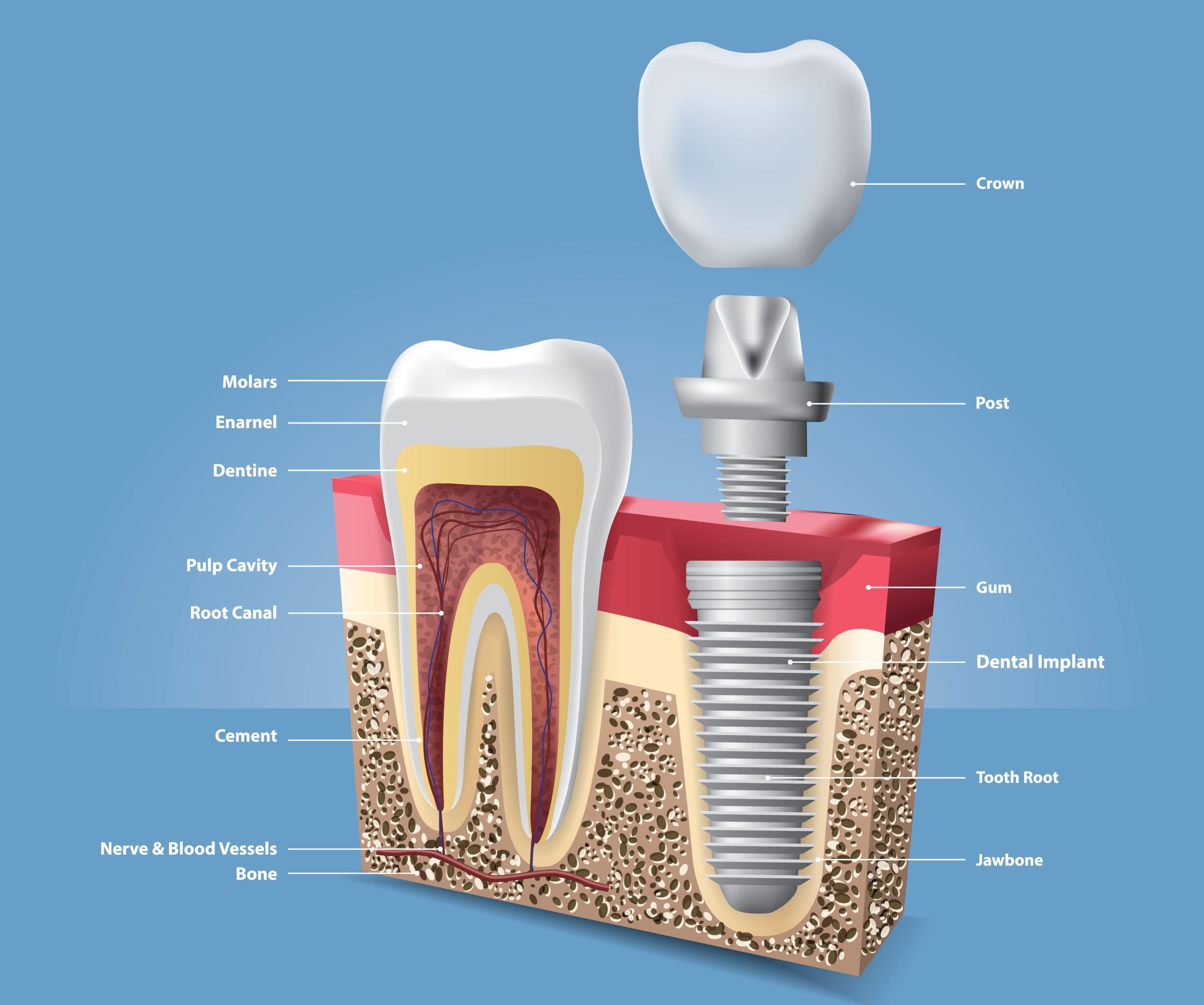 dental implant treatment in Indore, implantologist in indore