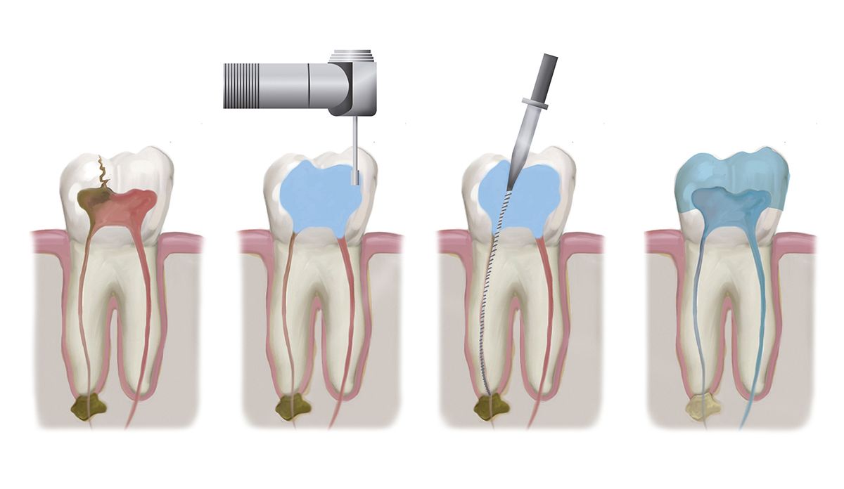 root canal treatment in indore, rct in indore