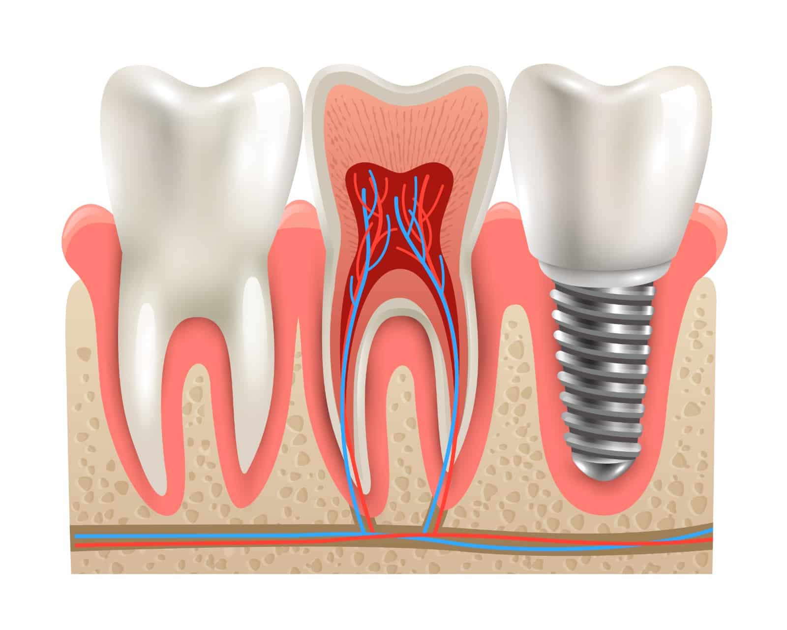 dental Implants in Indore, implantologist in indore