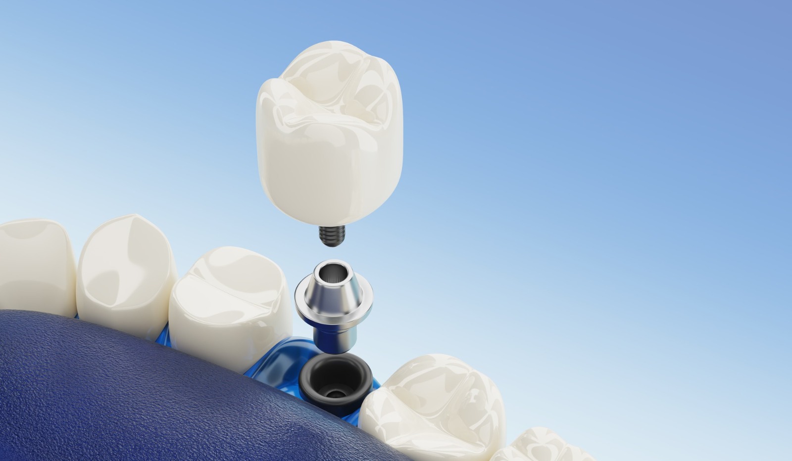 single tooth implants in indore, best dentist for implants in indore