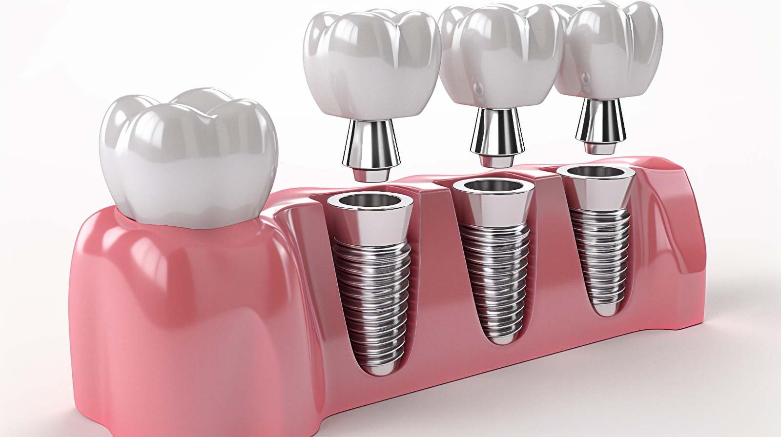 dental implants in indore, best dental implants in indore, dental implant cost in indore, tooth implant cost in indore, best dental implants in indore, dental implants doctor in indore, dentist indore, dentist in indore, orthodontist in indore, implantologist in Indore