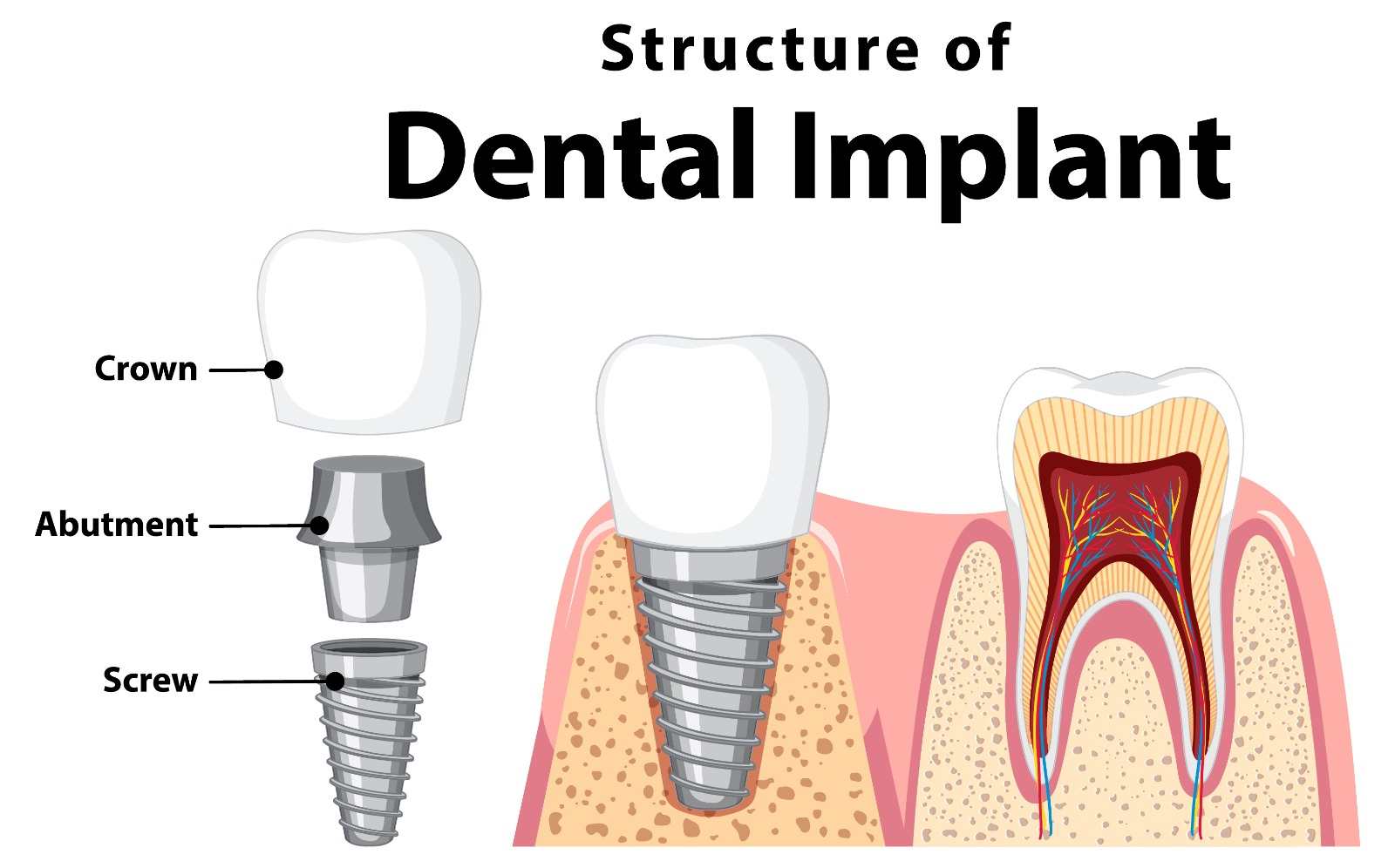 dental implants in indore, best dental implants in indore, dental implant cost in indore, tooth implant cost in indore, best dental implants in indore, dental implants doctor in indore, dentist indore, dentist in indore, orthodontist in indore, implantologist in Indore