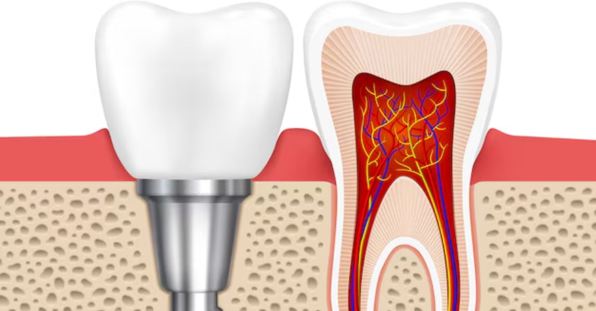 best dentist for root canal treatment in Indore