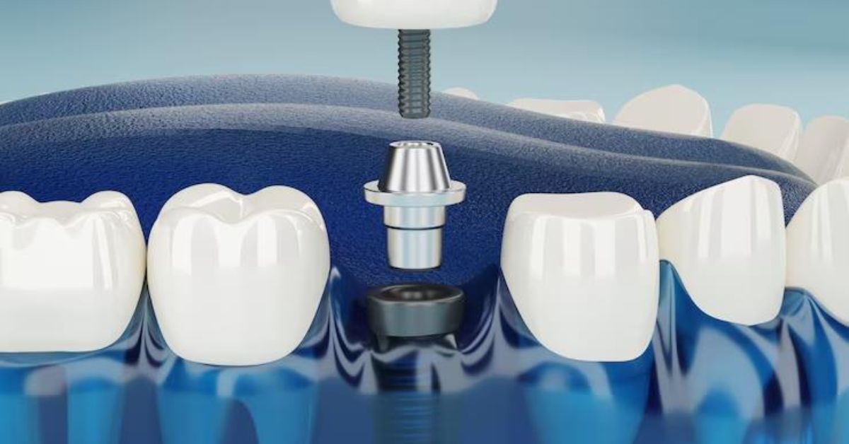 best dental implants in indore, dental implants in indore
