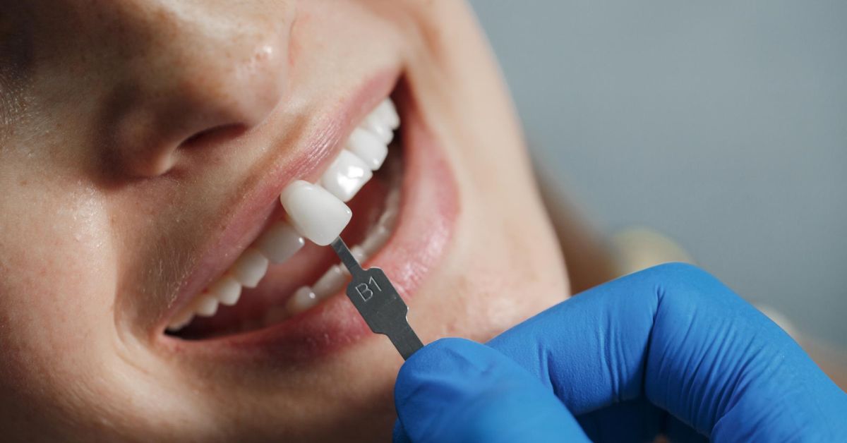 best dental implants in indore