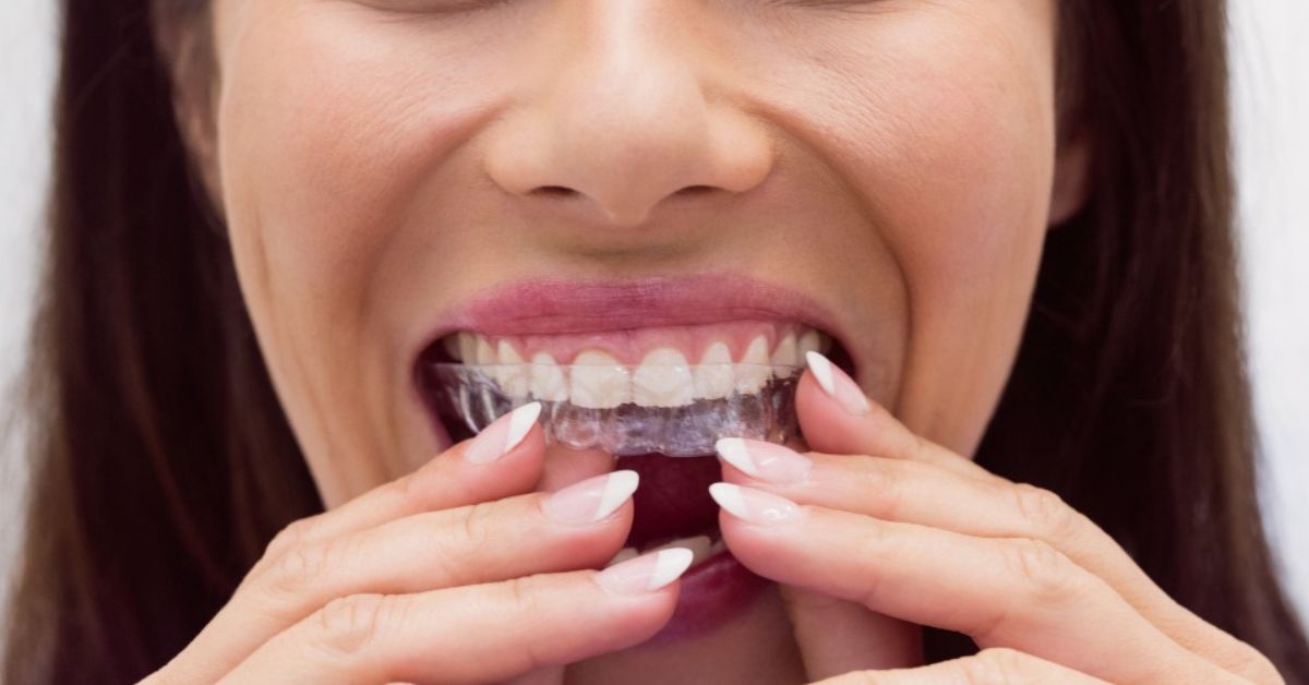 invisible teeth aligners in indore