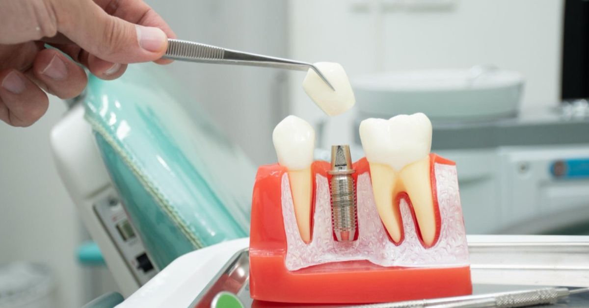 best dental implant doctor in indore