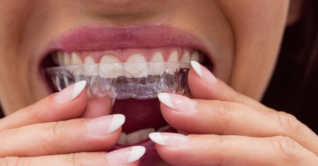 Person using invisalign clear aligners for invisible teeth alignment in Indore to improve smile discreetly