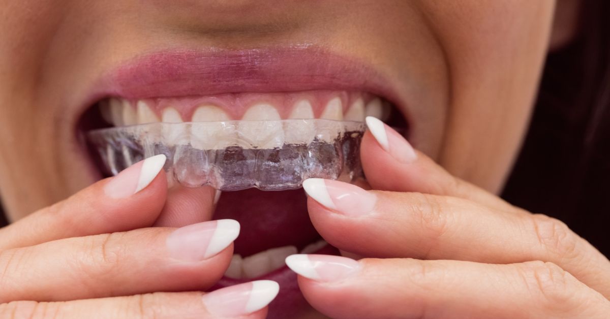 Person using invisalign clear aligners for invisible teeth alignment in Indore to improve smile discreetly
