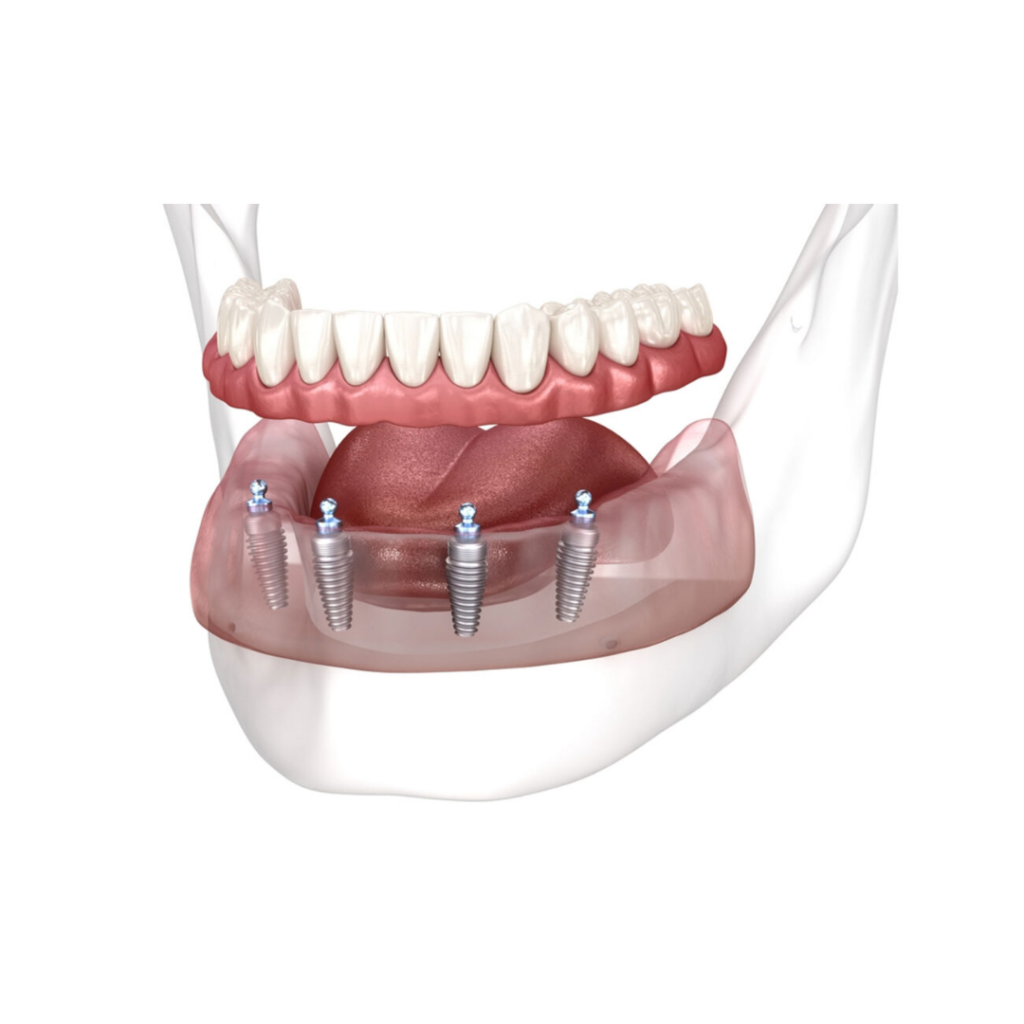 Dentures, Crowns & Bridges​