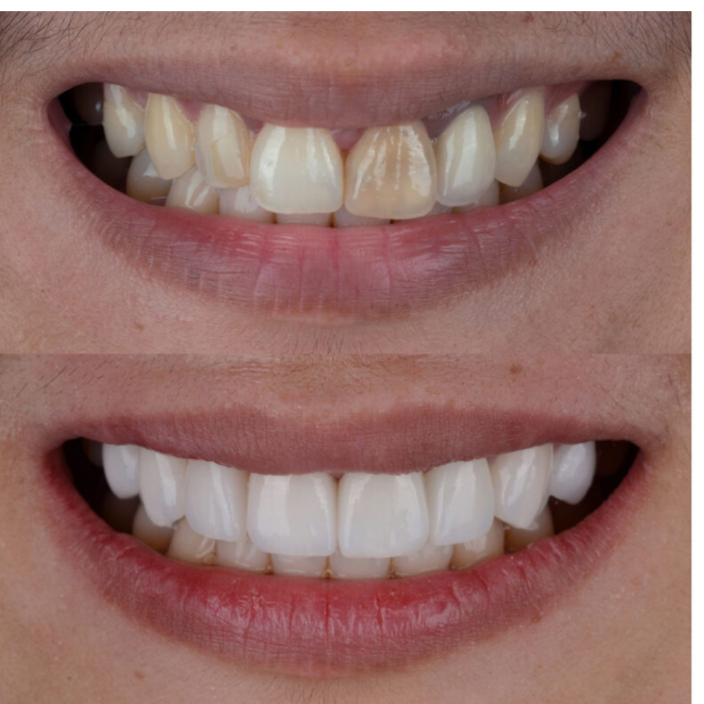 Smile Design & Makeover in Indore