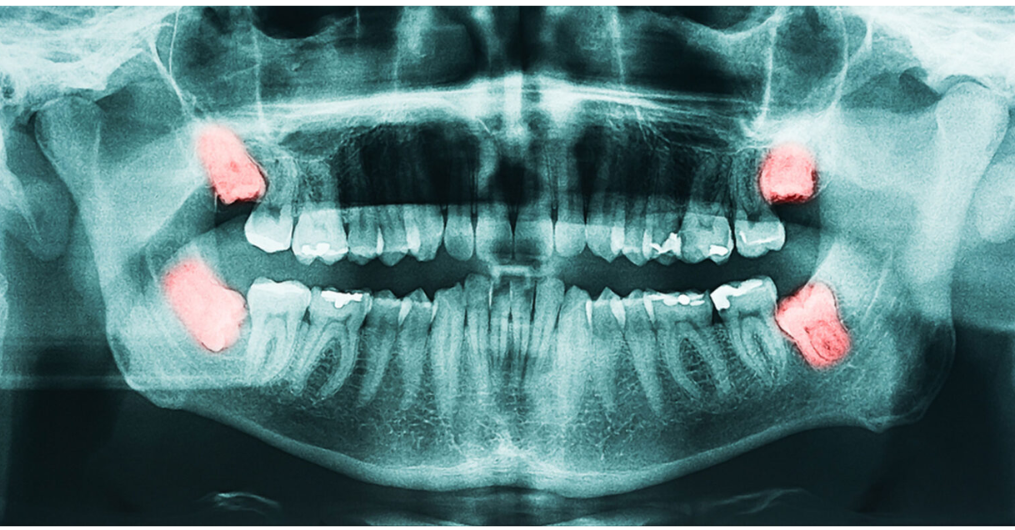 Wisdom Tooth Removal in Indore