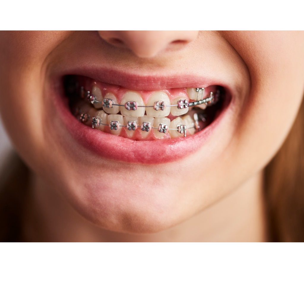 braces in indore