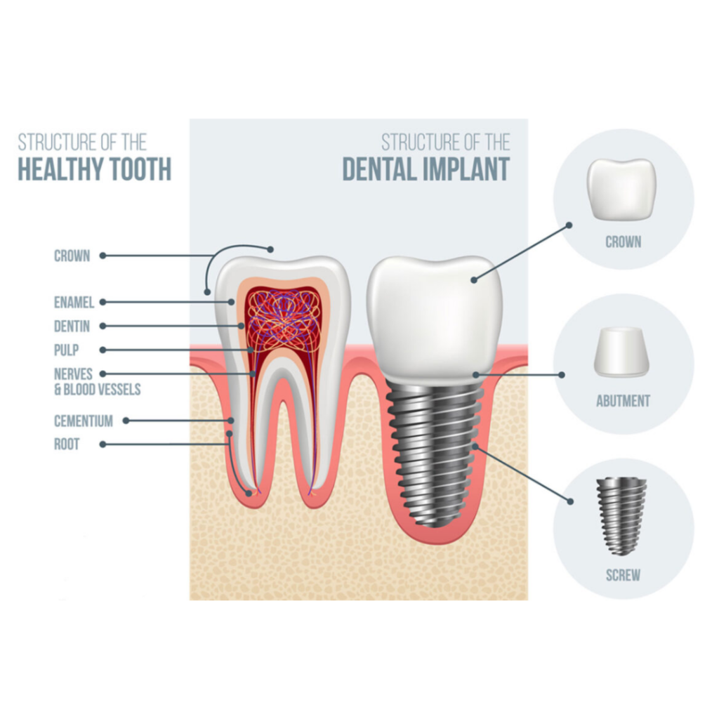 dental implant in indore
