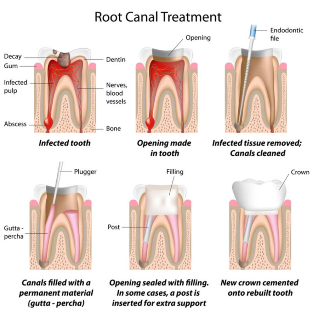 root canal treatment in indore