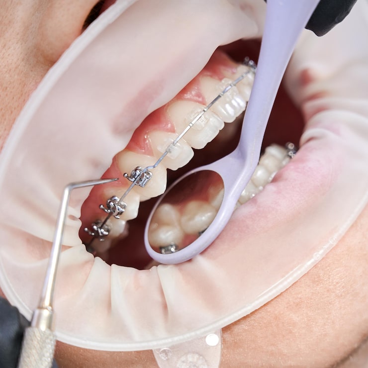 Confident smile after braces treatment in Indore