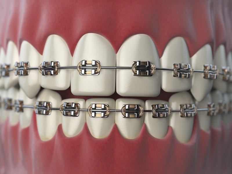 Braces treatment and orthodontic tooth alignment in Indore