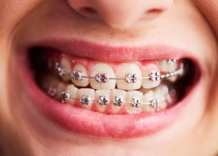 Braces treatment in Indore